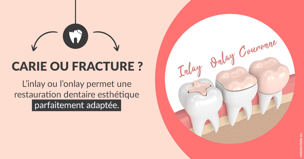 https://dr-belorgey-pierre.chirurgiens-dentistes.fr/T2 2023 - Carie ou fracture 2