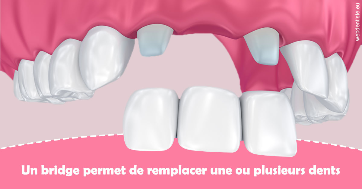 https://dr-belorgey-pierre.chirurgiens-dentistes.fr/Bridge remplacer dents 2