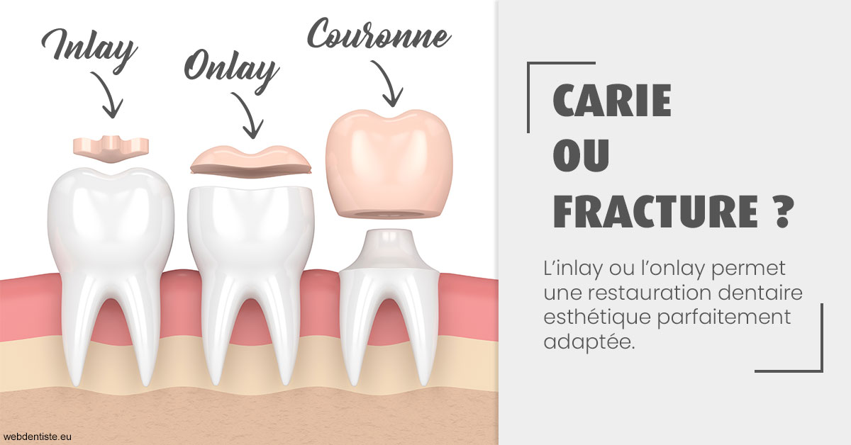 https://dr-belorgey-pierre.chirurgiens-dentistes.fr/T2 2023 - Carie ou fracture 1