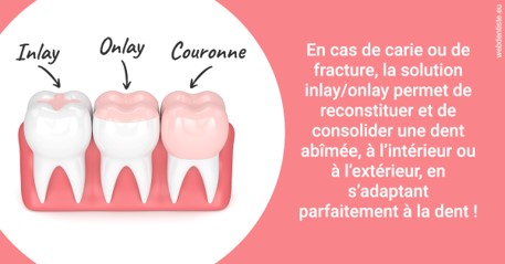 https://dr-belorgey-pierre.chirurgiens-dentistes.fr/L'INLAY ou l'ONLAY 2