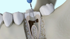 Protocole de dévitalisation d'une dent ou traitement endodontique